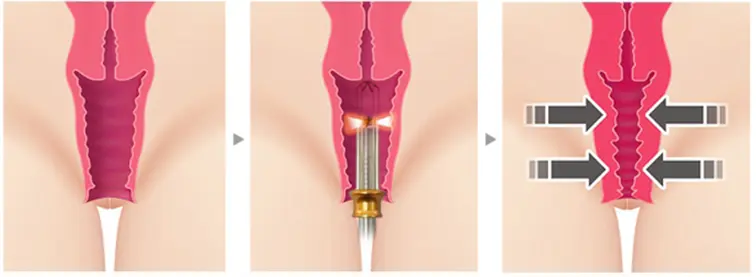 What is Genital Aesthetics Laser