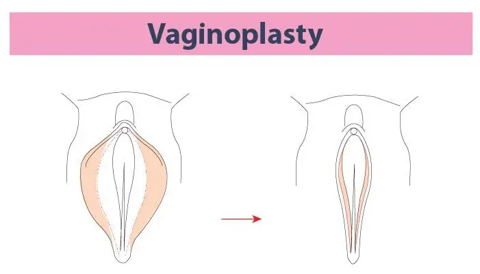 What is Genital Aesthetics Vaginoplasty