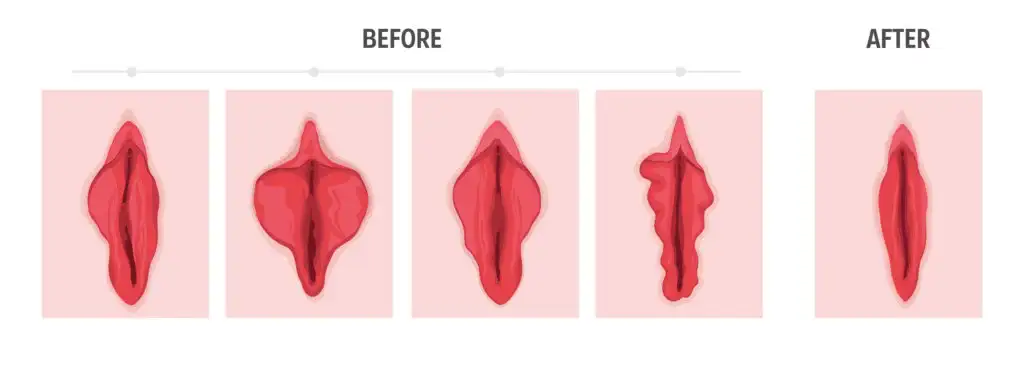 Labioplasti Ameliyatı Nasıl Yapılır? İç Dudak Estetiği - Labia Minora 2025