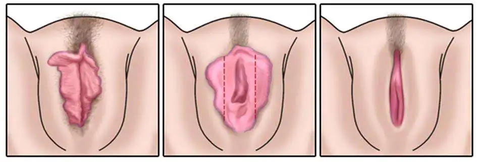 Labioplasti Ameliyatı Nasıl Yapılır? İç Dudak Estetiği - Labia Minora