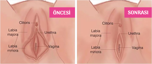 Labioplasti Ameliyatı Nasıl Yapılır öncesi sonrası