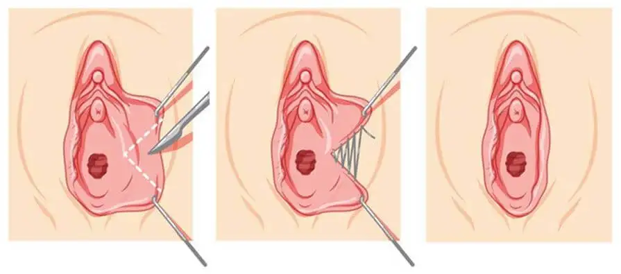 Genital Estetik Yöntemleri Labioplasti