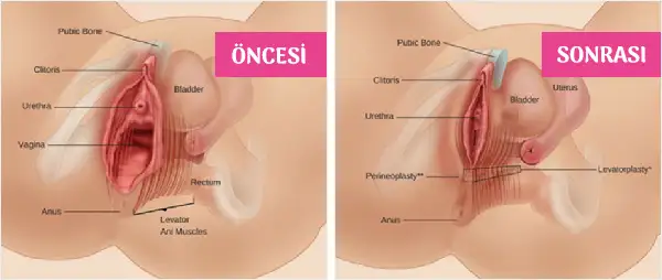 Genital Estetik Yöntemleri Vajinoplasti