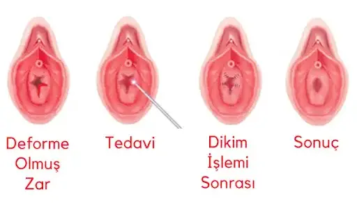Kızlık Zarı Dikimi Ameliyatı