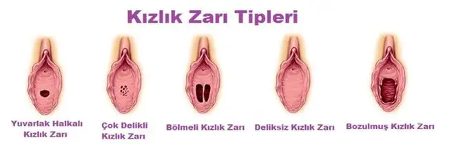 Kızlık Zarı Dikimi Başarı Oranı